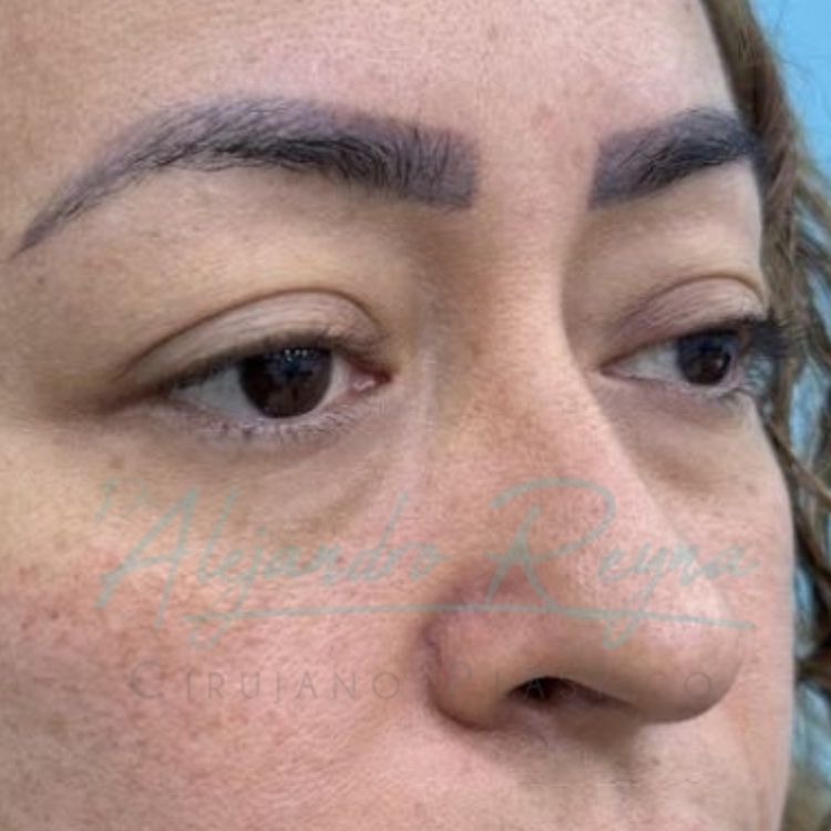 Antes de blefaroplastia — Dr. Alejandro Reyna, cirujano plástico Guatemala