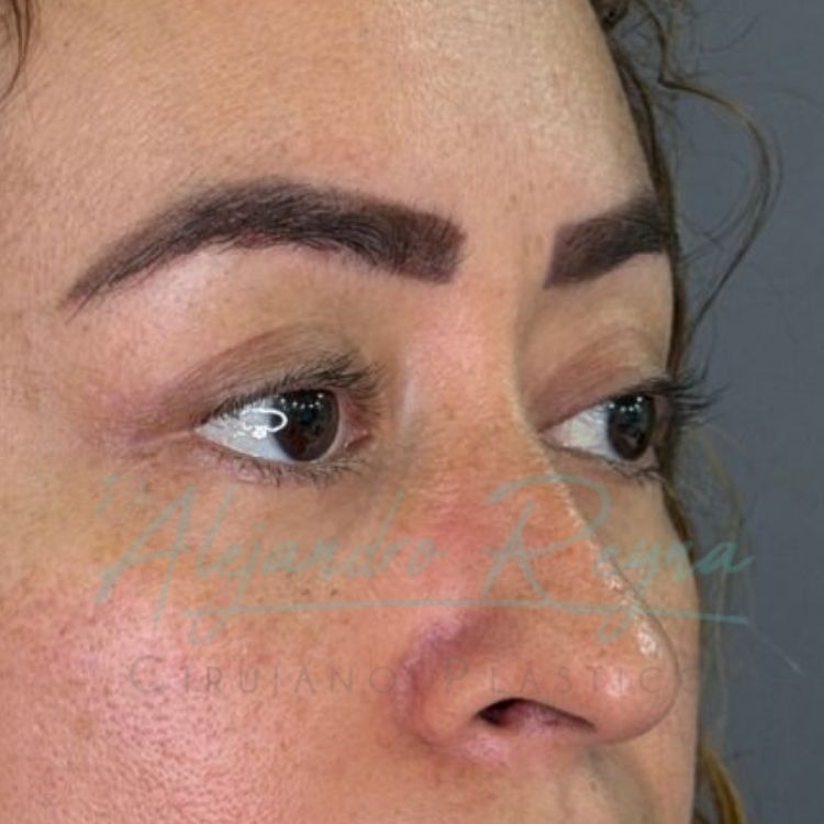 Después de blefaroplastia — Dr. Alejandro Reyna, cirujano plástico Guatemala