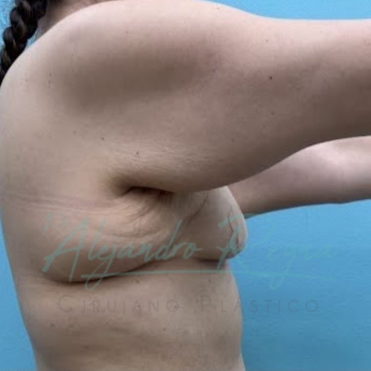 Antes de braquioplastia — Dr. Alejandro Reyna, cirujano plástico Guatemala