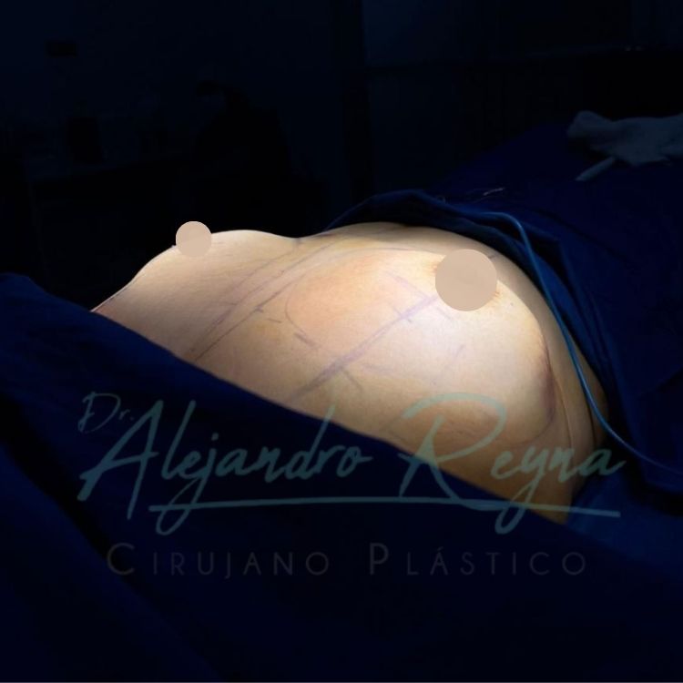 Antes de levantamiento mamario con implantes — Dr. Alejandro Reyna, cirujano plástico Guatemala