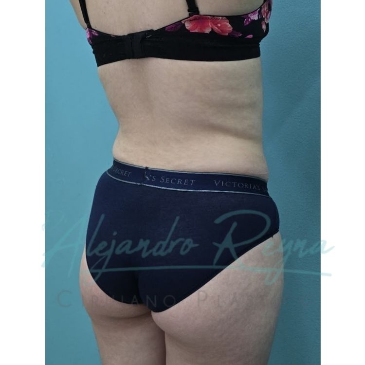 Antes de lipoescultura — Dr. Alejandro Reyna, cirujano plástico Guatemala