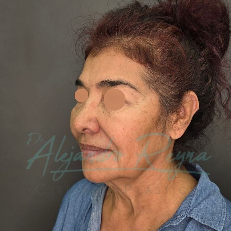 Antes de ritidoplastia — Dr. Alejandro Reyna, cirujano plástico Guatemala